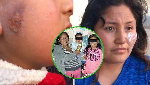 Mamá e hijito testigos del ataque a Juanita Mendoza también sufrieron quemaduras (VIDEO)