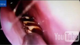 ​¡Para no creerlo! Fue por dolor de cabeza y médicos le encontraron este repugnante insecto (VIDEO)