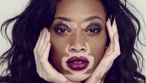 7 mentiras sobre el vitiligo que debes olvidar