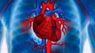 Hallan 10 nuevas características genéticas asociadas al infarto de miocardio 