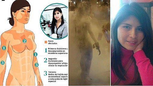 ¿Cuáles son las 15 operaciones que necesita Eyvi Liset Ágreda tras ser quemada viva? 