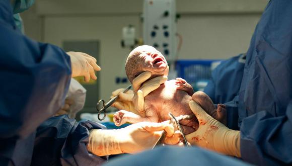 ¿Es la cesárea perjudicial para el bebé?