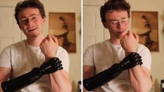 Joven de 25 años muestra al mundo cómo es vivir con una mano biónica