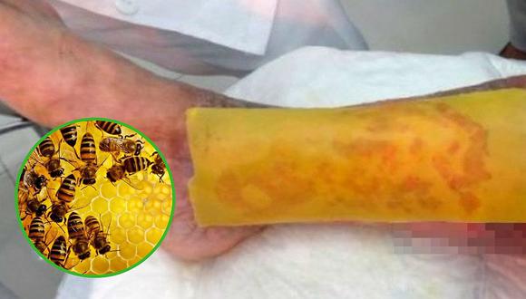 Crean parche natural de miel para tratar heridas de pie diabético