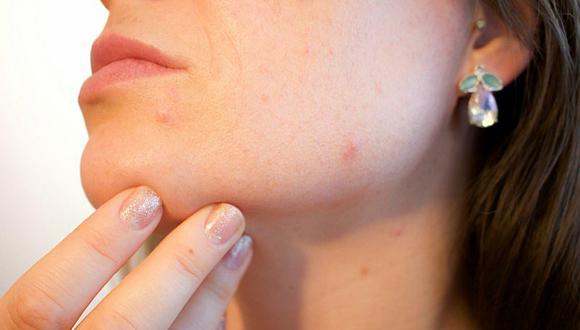 6 remedios caseros que nunca debes emplear para tratar el acné