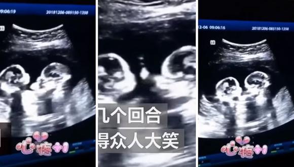 YouTube: ecografía capta "pelea" entre gemelas en el vientre de su mamá (VIDEO)