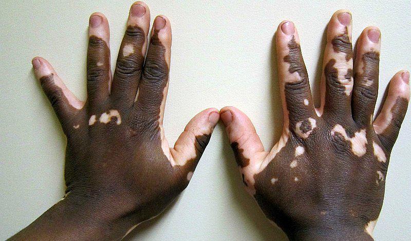 ¿Cuáles son las causas de la aparición del vitíligo? 