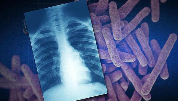 Tuberculosis tiene capacidad biológica camaleónica y se adapta a todo lugar