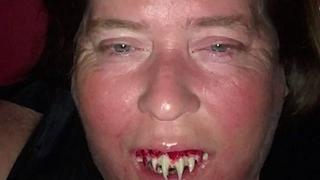 ​Mujer se puso colmillos por Halloween y terminó en emergencias (FOTOS)