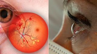 COVID 19: Problemas en la retina podrían ser síntomas del coronavirus