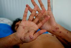 Viruela del mono 3 puntos clave para evitar su contagio