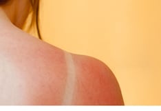 Prevención de quemaduras solares en la piel