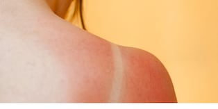 Prevención de quemaduras solares en la piel