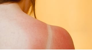 Prevención de quemaduras solares en la piel