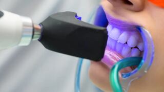 5 tips para realizarse un blanqueamiento dental con éxito