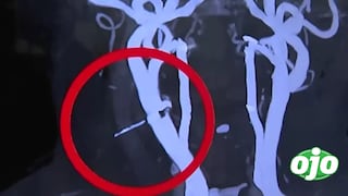 Mujer de 68 años sobrevive tras cirugía cardiovascular de emergencia por ingesta de clavo