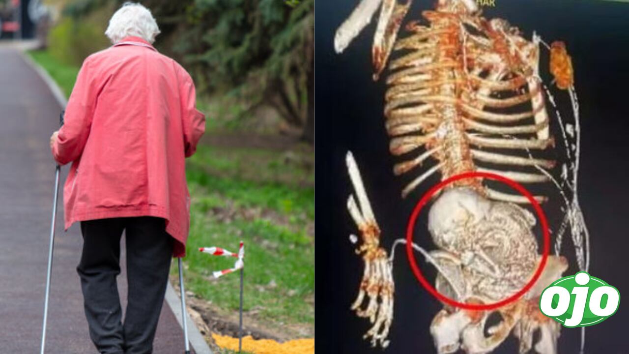 Brasil: Adulta mayor acude al hospital por dolor de estómago y médicos le encuentran ‘feto calcificado’