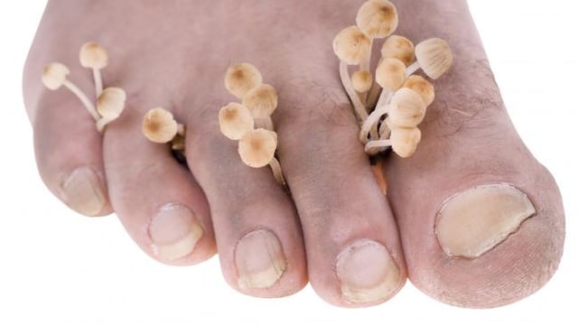 EsSalud advierte que casos de hongos en pies y uñas se triplican en verano 