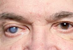 Glaucoma: la enfermedad silenciosa que pone en riesgo tu visión y cómo prevenirla