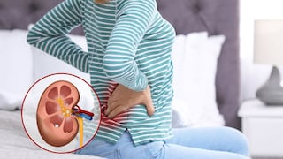 Comer para vivir: Cálculos renales aumentan en verano