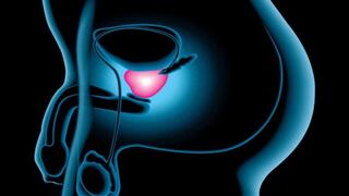 Día Mundial del Cáncer de próstata: Mitos y verdades que debes tener en cuenta