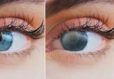 Cataratas en los ojos: 80% de personas que padecen este mal pueden encontrar solución con cirugía