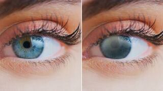 Cataratas en los ojos: 80% de personas que padecen este mal pueden encontrar solución con cirugía