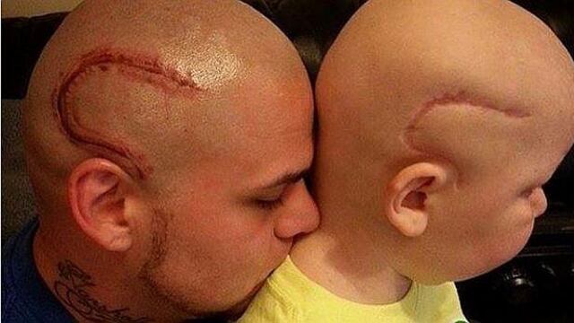 Instagram: Padre se tatúa cicatriz igual al de su hijo con cáncer para apoyarlo 