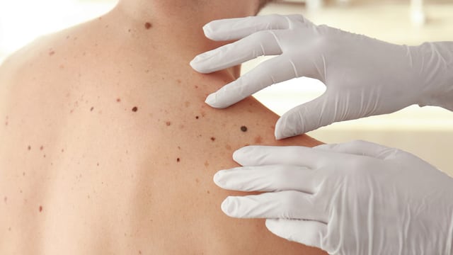 Melanoma cutáneo maligno: ¿Cómo prevenir el cáncer de piel más agresivo y letal?