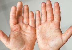 Identifican caso importado de sarampión en joven de 21 años