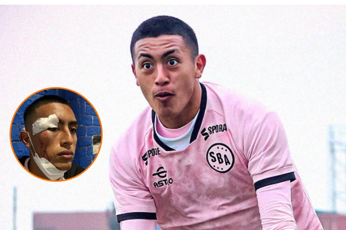 Fabrizio Roca presenta tres puntos en la ceja tras ser atacado por vándalos. Foto: Sport Boys/Gustavo Peralta