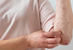 Casos de sarampión en aumento: claves para su detección y prevención