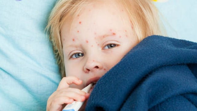 Cómo proteger al bebé de la varicela