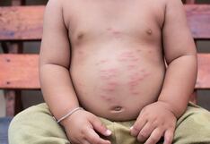 Comer para vivir: ¿Por qué algunos niños tienen alergia a los alimentos?