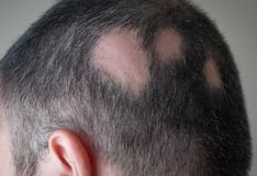 Caída de cabello en parches: ¿podría tratarse de alopecia areata?
