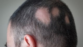 Caída de cabello en parches: ¿podría tratarse de alopecia areata?