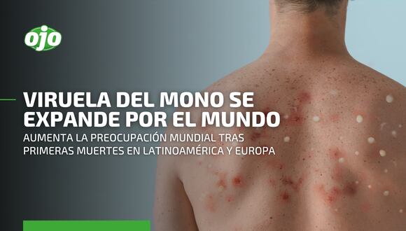Viruela del mono: enfermedad sigue expandiéndose con consecuencias negativas en todo el mundo