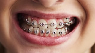 Brackets: ¿Cuáles son las consecuencias de una mala higiene durante una ortodoncia?