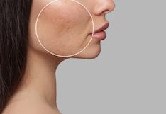 Secuelas del acné: la lucha continua por una piel perfecta