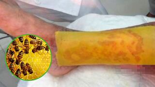 Crean parche natural de miel para tratar heridas de pie diabético