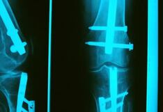 La columna de Pérez Albela: Pernos de magnesio