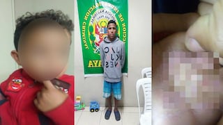 Arequipa: Venezolano quema manos a su hijo de un año tras discutir con su pareja