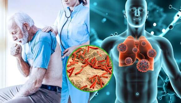 Día mundial de la tuberculosis: ¿Cuáles son los signos y síntomas de esta enfermedad? | MUJER | OJO
