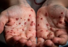 ¿Cómo prevenir la enfermedad de manos, pies y boca?