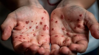 ¿Cómo prevenir la enfermedad de manos, pies y boca?