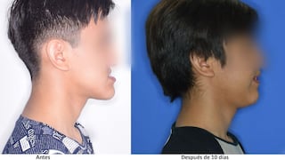 INSN Breña: Cinco adolescentes transformaron su vida gracias a innovadora cirugía ortognática mínimamente invasiva para corrección de mordidas