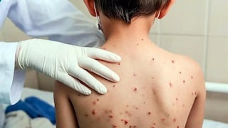 Casos de sarampión y tos ferina en alza