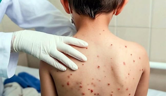 Las complicaciones del sarampión pueden ser tan graves que incluso pueden causar la muerte. Foto: Istock.