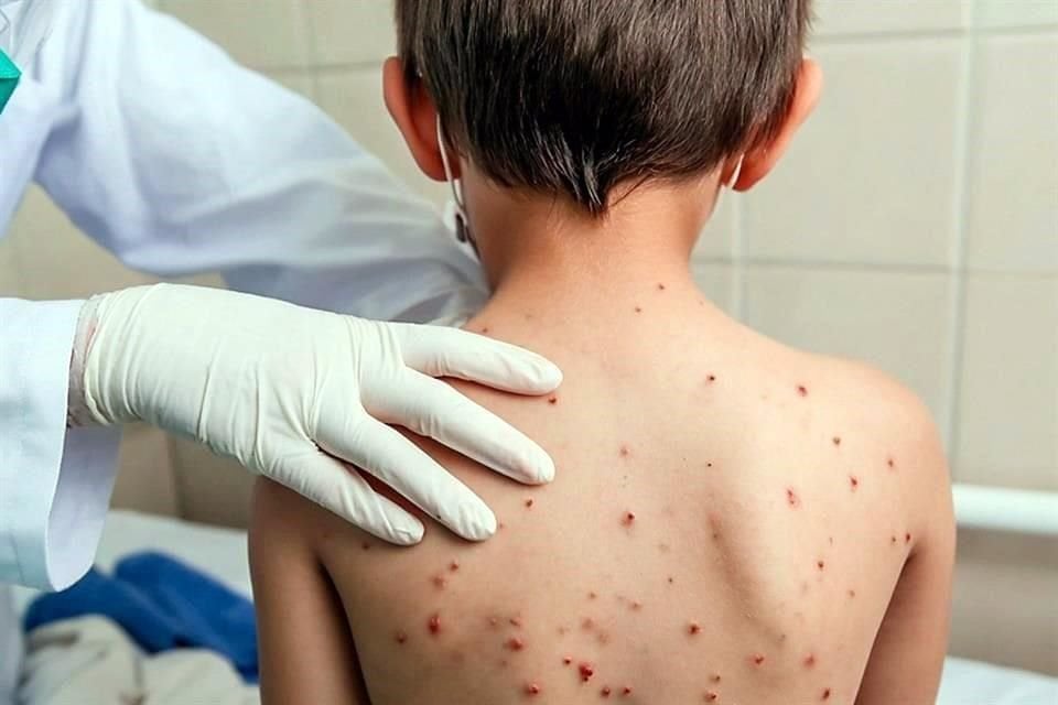 Las complicaciones del sarampión pueden ser tan graves que incluso pueden causar la muerte. Foto: Istock.