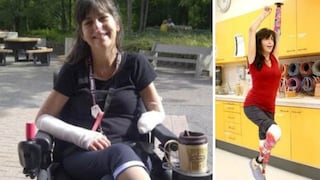 Mujer pierde las piernas y la mano por mordedura de su perro